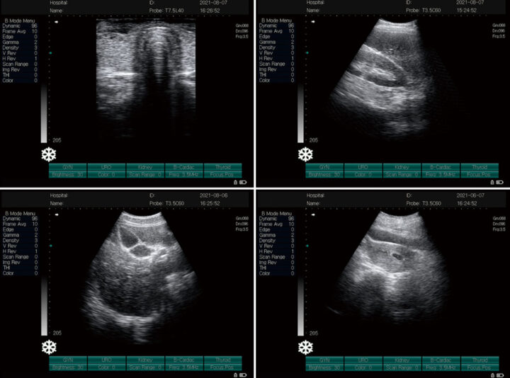 BN100 Laptop B Ultrasonic Images